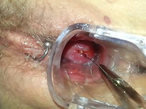 Mirena Spirale penghapusan ziehen IUD IUP entfernen